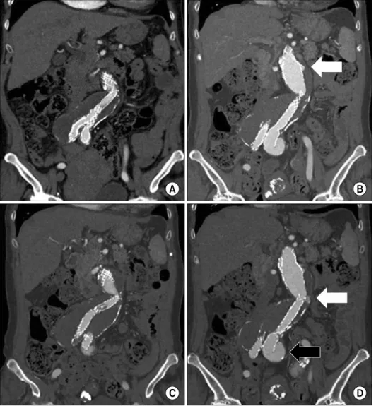 Fig. 2. CTA after endovascular aort- aort-ic repair. (A) The CTA images taken  immediately postoperatively show  the kinked endograft making  con-tact with the aortic wall