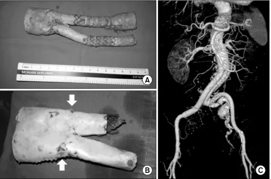 Fig. 3. Gross images of the pre- pre-viously inserted SEAL stent graft  are shown in A and B