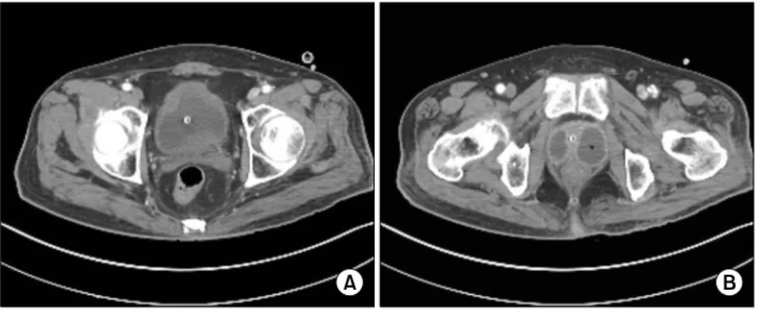 Fig. 2. (A) Interval improvement of em- em-physematous cystitis. (B) Decreased  pro-static abscess size.