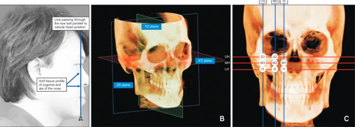 Figure 1. Inclusion criteria for the midface deficiency group. A, Soft-tissue profile with the zygoma and ala of the  nose located behind the line passing through the eyeball parallel to the natural head position