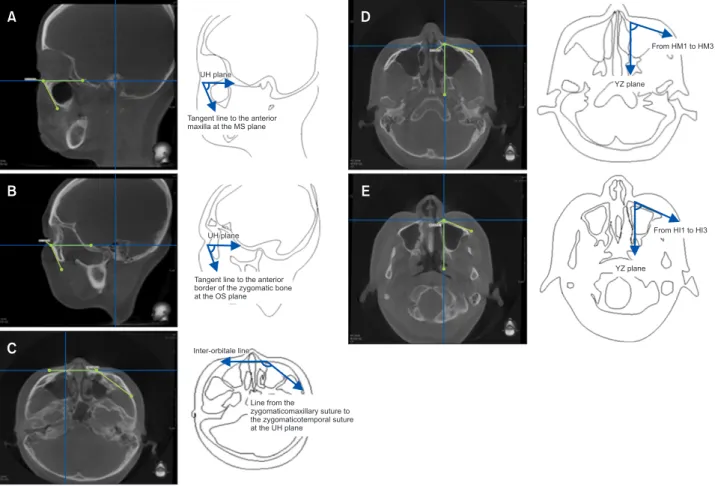 Figure 3. Angular measurements. A, Sagittal maxillary angle (SMA). B, Sagittal zygomatic angle (SZA)