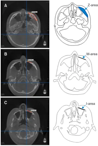 Figure 4. Surface area measurements. A, Zygomatic area  (Z-area).  B, Middle maxillary area (M-area)