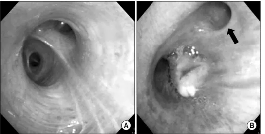Fig. 2. Bronchoscopy. (A) Only two  segmental bronchi arose from right  upper lobar bronchus