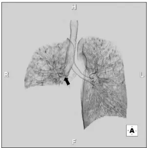 Fig. 4. Illustration of the sleeve anastomosis. (A) Red dashed-lines represented resection sites
