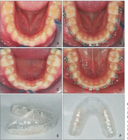 Figure 1. The appliances us ed  in this study. A, Nickel-titanium  (NiTi) group before treatment; 