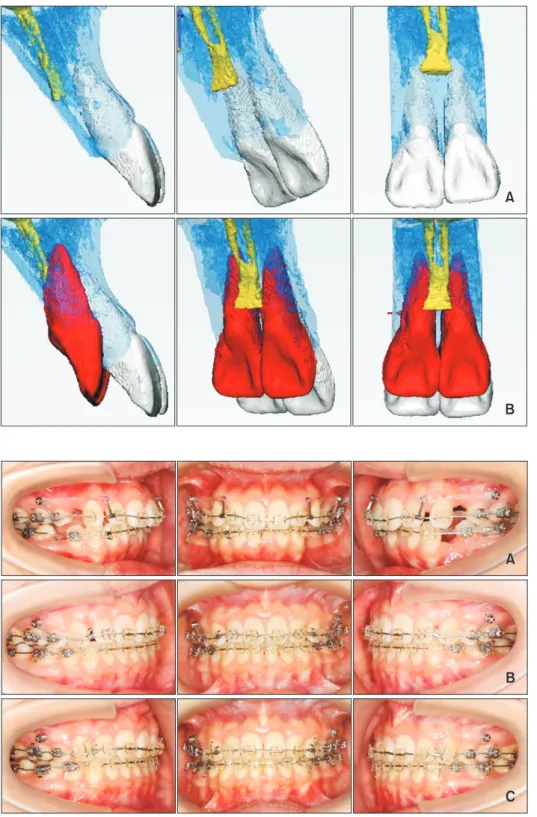 Figure 4. Three-dimensional  ana to mical structures in the  max illary anterior region