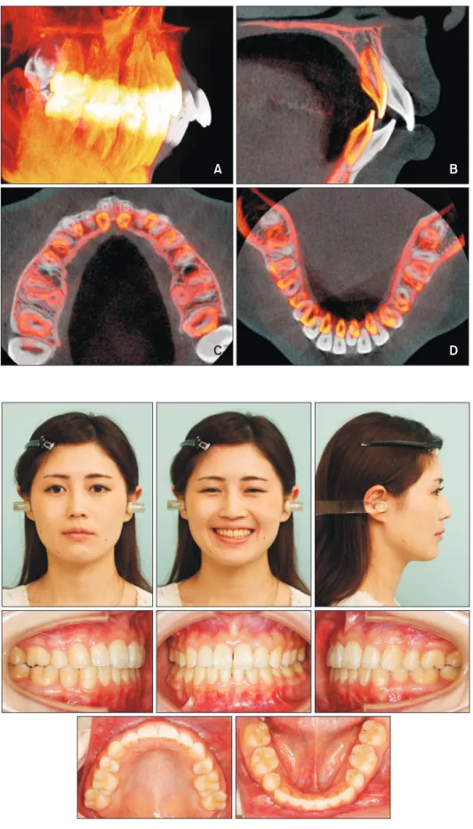 Figure 11. Three-dimensional  cone beam computed  tomogra-phy superimposition registered  to the cranial base after  orth-odontic treatment