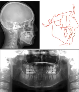 Figure 13. A post-retention lateral cephalogram and an  orthopantomogram and superimposed tracings of  post-treatment (red) and post-retention (green) cephalograms.