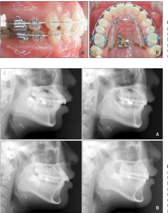 Figure 4. Mid-treatment oral  photographs in the premolar  extraction and nonextraction  (modified C-palatal plate)  groups