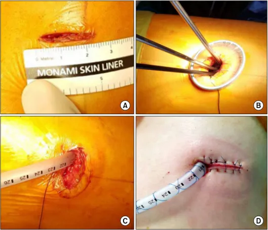 Fig. 1. (A) A minimal thoracotomy  incision of 2.0 to 3.0 cm was made  in the sixth intercostal space