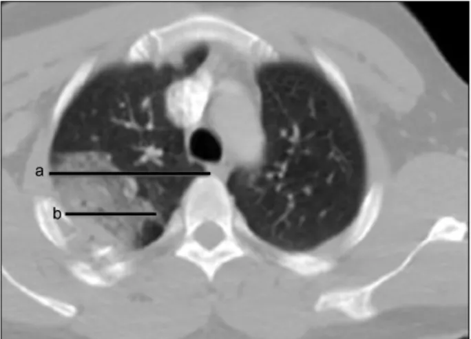 Fig. 1. The PCS. The PCS is determined by summing each of the  lengths (a and b). a: The length of the transverse axis of the lobe  with the largest pulmonary contusion visualized by computed  to-mography of the chest