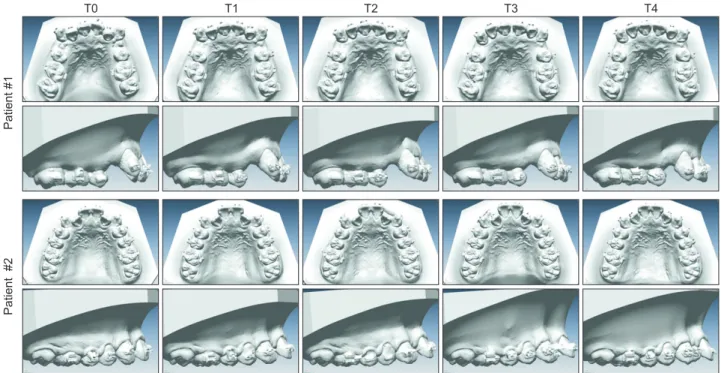 Table 2 shows an inconstant tooth movement and  a large standard deviation. The reason may be that  the malocclusion of patients was diverse and proper  treatment methods were inevitably inconsistent