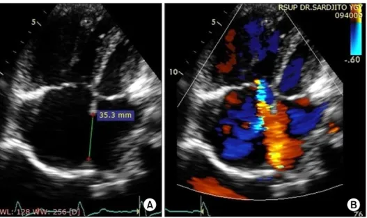 Fig. 2. (A, B) Transthoracic echo- echo-cardiogram showing a large tissue  defect of 35 mm, with a  bidirec-tional shunt through the interatrial  septum.