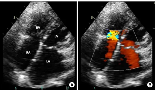 Fig. 3. (A, B) Transthoracic echo- echo-cardiogram showing no residual  leakage with normal RA, RV, LA,  and LV diameters
