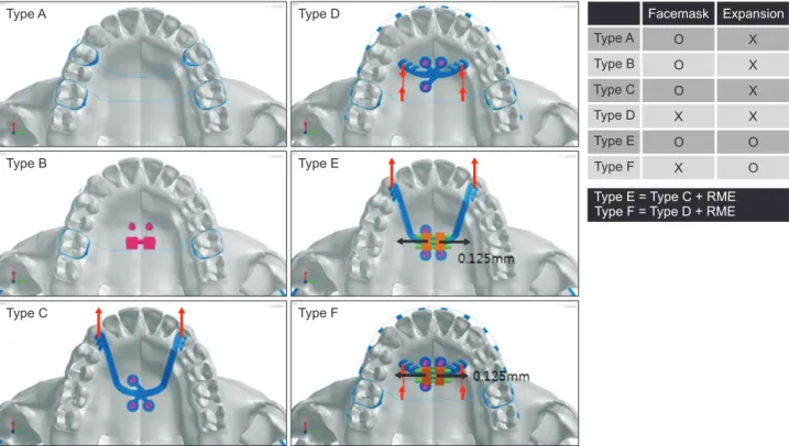 Figure 2. Schematic illustration of the appliance designs. Type A: conventional tooth-borne facemask; Type B: hybrid- hybrid-hyrax appliance with facemask; Type C: modified C-palatal plate (MCPP) with facemask; Type D: Class III MCPP anchorage  with intrao