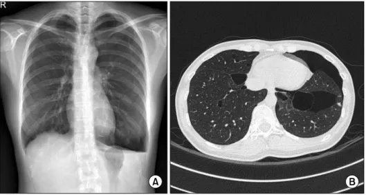 Fig. 1. (A) A chest X-ray showing a  left-sided pneumothorax. (B) A chest computed tomography scan reveals  left-sided pneumothorax with the  lower lung predominant, and  sev-eral variably-sized thin-walled air  cysts in both lungs.