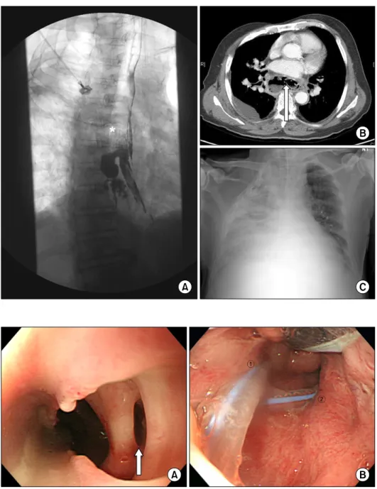 Fig. 1. Initial workup images. (A)  Gastrografin esophagogram showing  a perforation (*) in the middle of  the thoracic esophagus