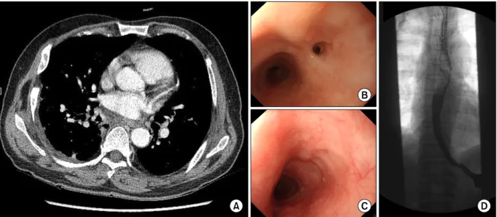 Fig. 3. Follow-up CT scan, endoscopic image, and esophagogram. (A) Chest CT scan showing a notable decrease in the extent of the me- me-diastinal abscess