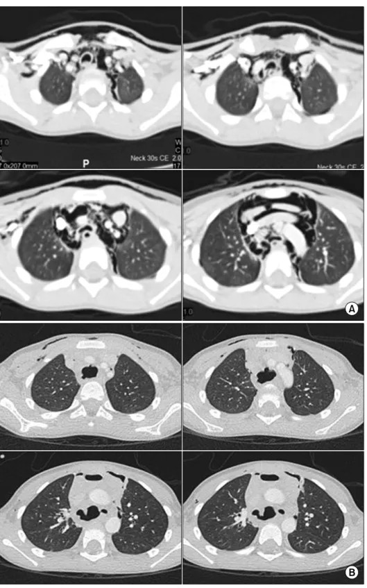 Fig. 1. (A) The initial CT scan shows  no significant findings in the  tra-cheobronchial tree, lung, or  eso-phagus
