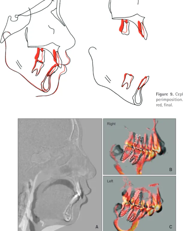 Figure 9. Cephalometric su- su-perimposition. Black, initial; 