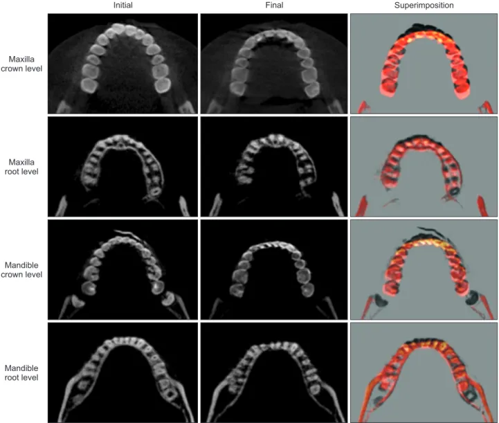 Figure 11. Changes in the arch form and tooth position following treatment. Axial cuts were made at the mid-crown  level and midroot level before and after treatment