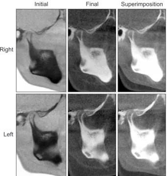 Figure 12. Three-dimensional cone-beam computed  tomography superimposition of the temporomandibular  joint