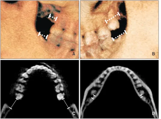 Figure 4. Posterior anatomic  limit for total distalization. A  and  B, The available space at  the maxillary tuberosity distal  to the second molars, and the  available space between the  mandibular second molar and  the anterior border of the  ramus in t