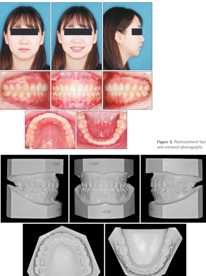Figure 7. Posttreatment dental casts.