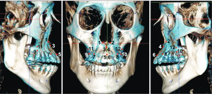Figure 4. Superimposition of three-dimensional cone-beam computed tomography images acquired before (white) and  after (blue) miniscrew-assisted rapid palatal expansion