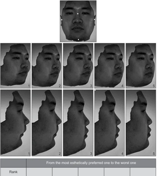Figure 2. Three-dimensional  (3D) facial scan images of a  man with an euryprosopic  facial type and modification  of the chin projection by  changing the facial profile  angle  (glabella–subnasale-pogonion) by gradations of  2 o  (1, moderately retrusive 