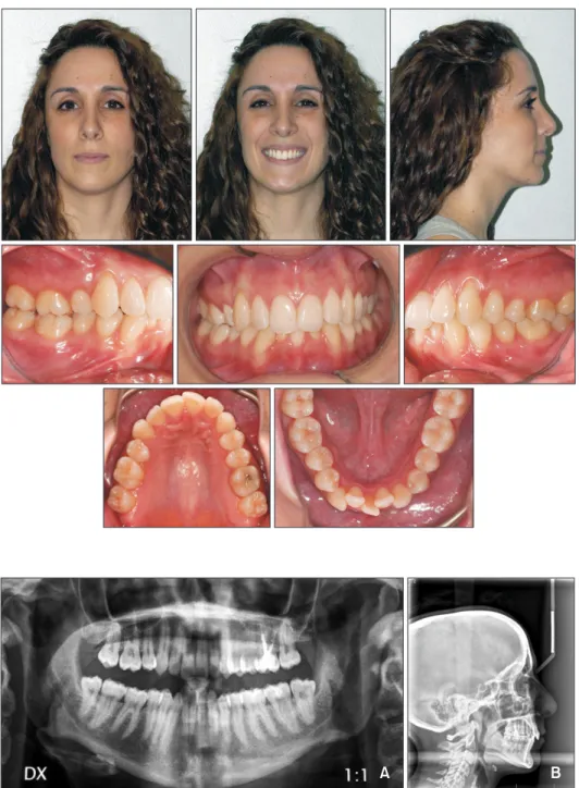 Figure 1. Pretreatment facial  and intraoral photographs.