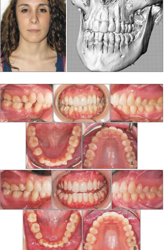 Figure 6. Intraoral pho to- to-graphs.  A, At 2 months of  treat ment;  B, at 4 months of  treat ment.