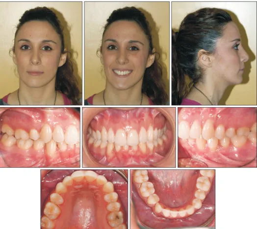 Figure 7. Facial and intra oral  photographs at the end of  treatment. 