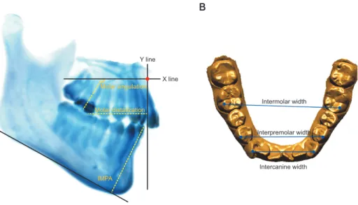 Figure 1. Measurements used in this study. A, Cone-beam computed tomography-generated half-cephalogram (CG  Ceph) measurements for maxillary molar distalization, maxillary molar angulation, and mandibular incisor inclination  (IMPA)