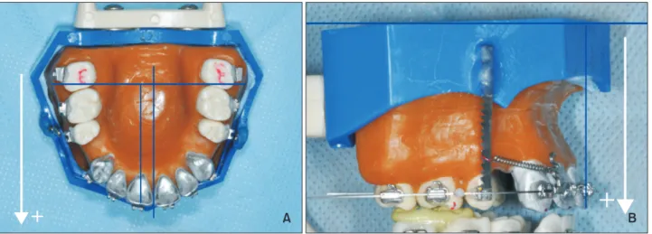 Figure 5. Set-up of the new typodont model. A first  premolar extraction case model consisting of sticky wax  alveolar bone, aluminum anterior and resin posterior  teeth, anterior hook, posterior anchorage bar, and Niti  coil spring for retraction.