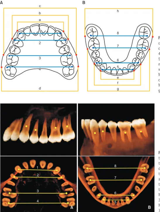 Figure 1. Dental arch width  on cast (DAW). A, Maxilla: 1,  canine; 2, premolar; 3, 1st molar; 