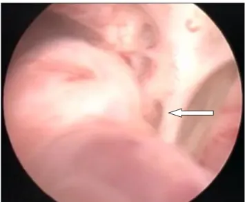 Fig. 3. Multiple diverticulums in the vicinity of the ejaculatory duct  (arrow) were observed on verumontanum intraoperative cystoscopy.