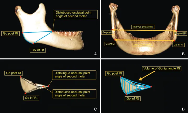 Table 1. Mean changes in masseter muscle thickness and masseter muscle cross-sectional area 6 months after botulinum  toxin type A injection in groups I and II