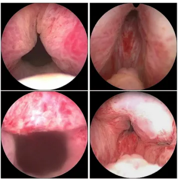 Fig. 1. Cystoscopic features before (upper) and after (lower) prostatic  urethral lift patients.