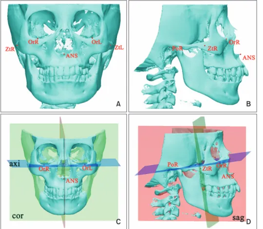 Figure 1. Reference planes  and landmarks used in the  study.  A, Frontal view of the  craniofacial bone