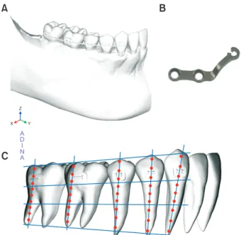 Figure 1. Construction of the finite element mode. A,  Teeth and mandibular model with brackets and an arch­