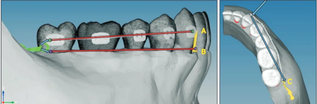 Figure 2. The vertical and horizontal position and direction of force vector. A, The bracket level force was engaged from  the center of the mandibular canine bracket slot to the disto­center of the mandibular second molar bracket slot (green  point)
