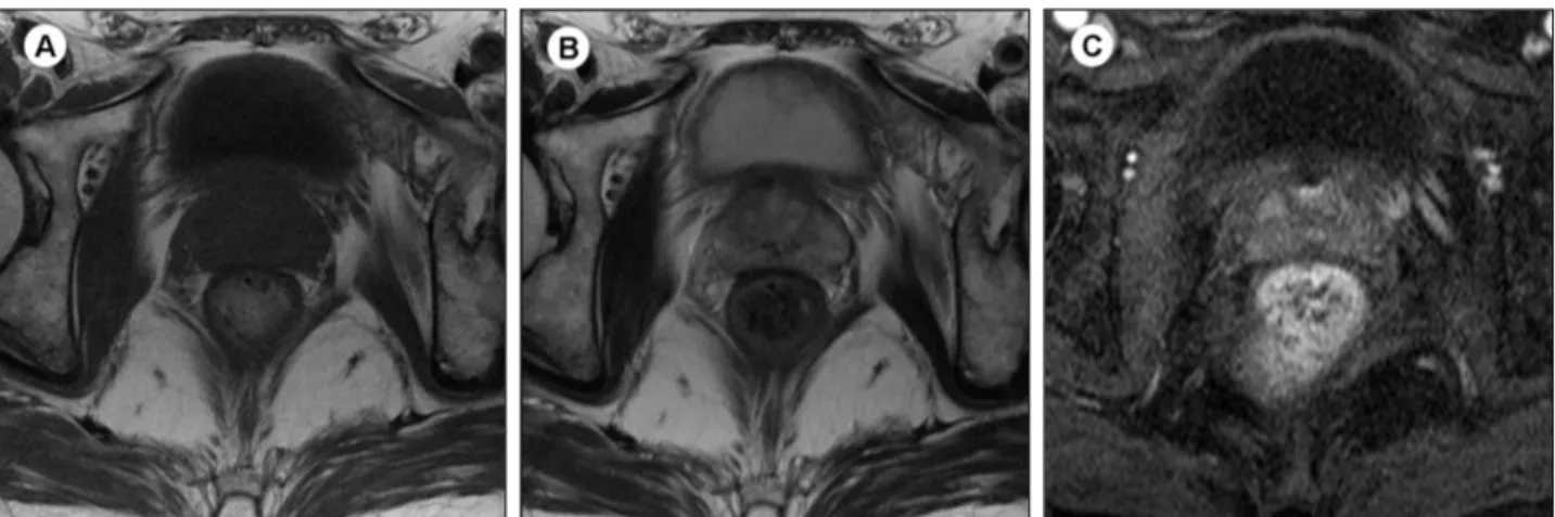 Fig.  4.  MRI  prostate,  Axial  T1  weighted  image  showed  no  definite  lesion  any  more  after  antituberculus  treatment  for  5months  (A)