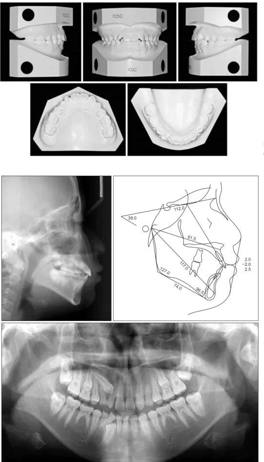 Figure 2. Pretreatment dental  casts.