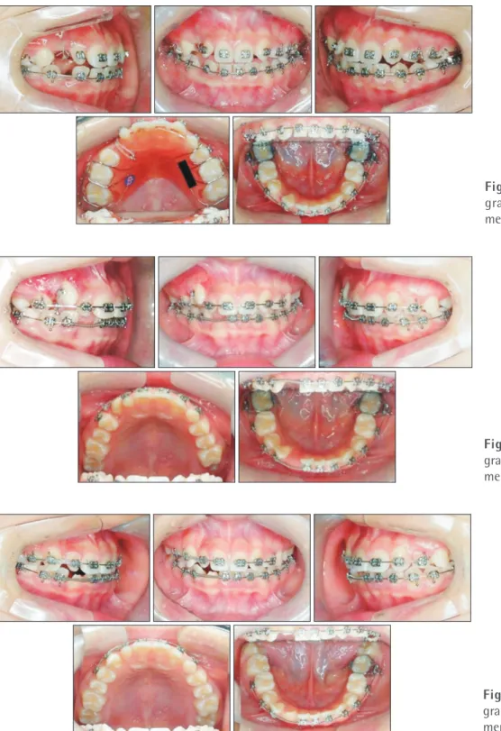 Figure 4. Intraoral photo­