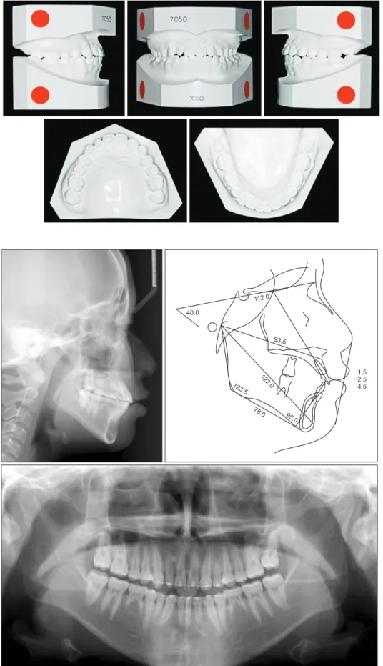 Figure 8. Post­treatment  dental casts.