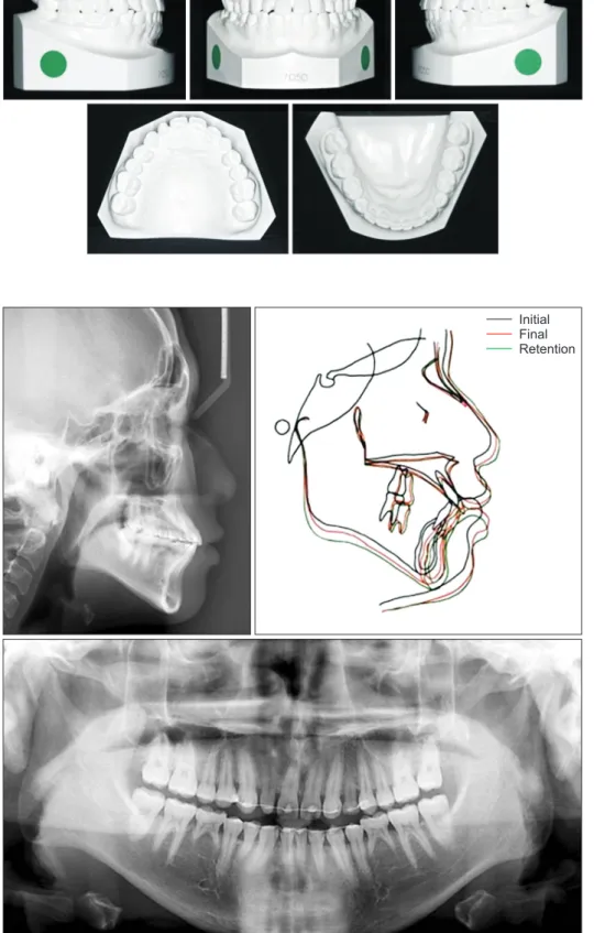Figure 12. Retention lateral  cephalogram, cephalometric  superimposition (before, after  treatment and after 5 years  retention) and panoramic ra­