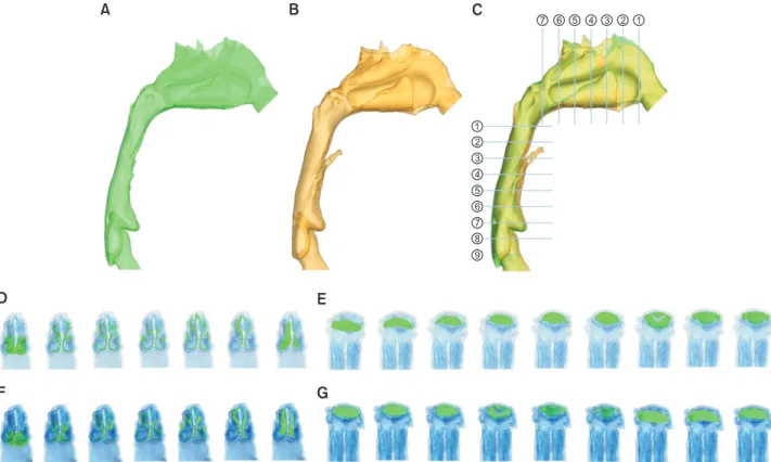 Figure 1. Three-dimensional models of the upper airway. T0 (A, green), T1 (B, yellow) and superimposition (C) of the  models showing the locations of seven planes in the nasal cavity and nine planes in the pharynx