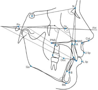 Figure 1. Linear cephalometric variables used for analysis  of the effects of cervical pull headgear or the modified  C-palatal plate.