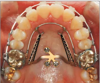 Figure 3. Force vectors associated with the modified  C-palatal plate. The solid line shows the force vector  when the most apical hook is engaged